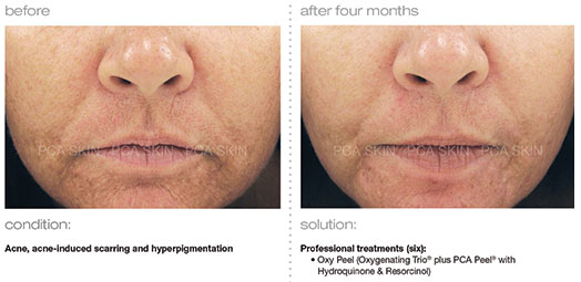 acne-acne-induced-scarring-hyperpigmentation