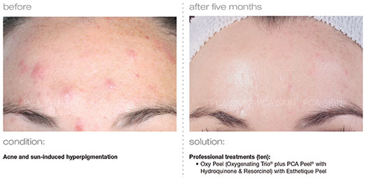 acne-sun-induced-hyperpigmentation
